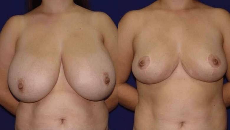 breast reduction surgery before and after