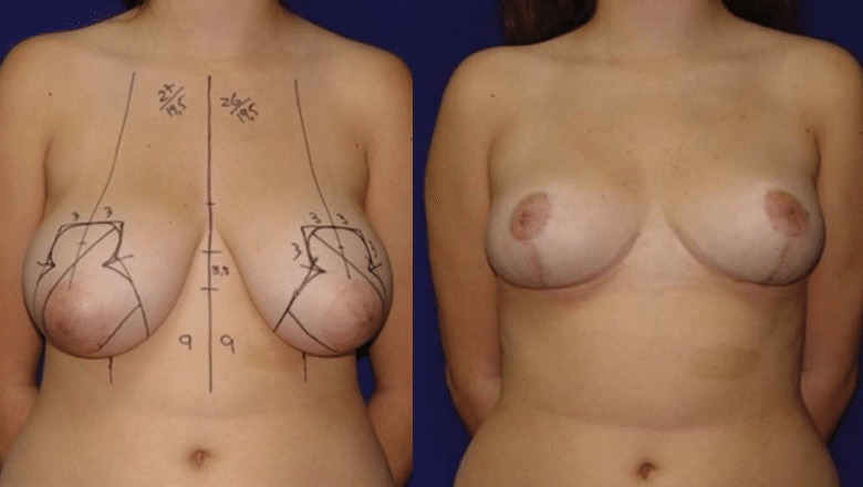 breast reduction surgery before and after