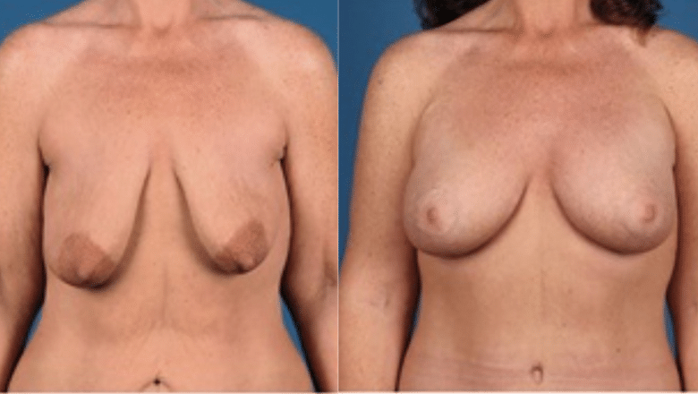 breast uplift before and after 4