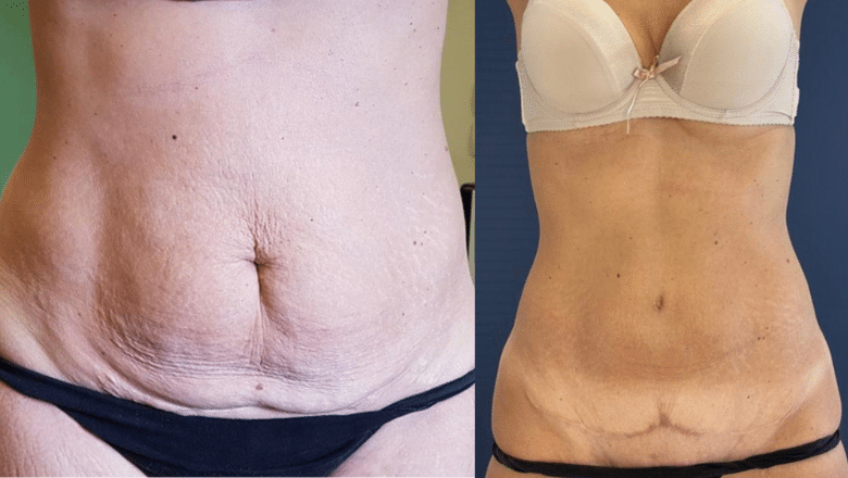 female tummy tuck before after