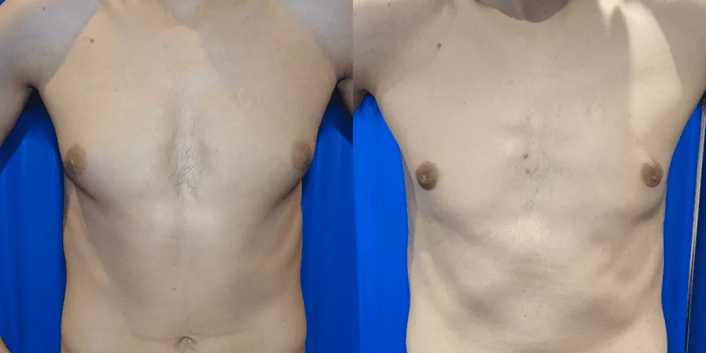 Does Gynecomastia Go Away?