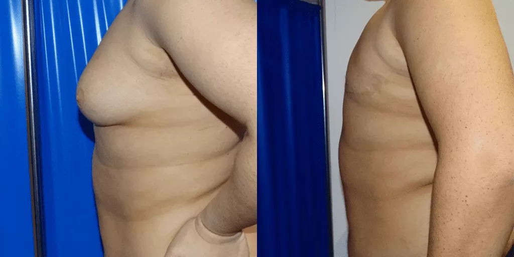 gynaecomastia-surgery-results.webp?format=webp&nv=ca64acd6-a6db-44c0-8ef1-3388dfd37a49