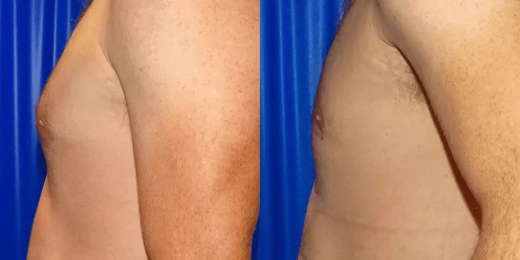 gynecomastia-before-and-after.webp?format=webp&nv=ca64acd6-a6db-44c0-8ef1-3388dfd37a49