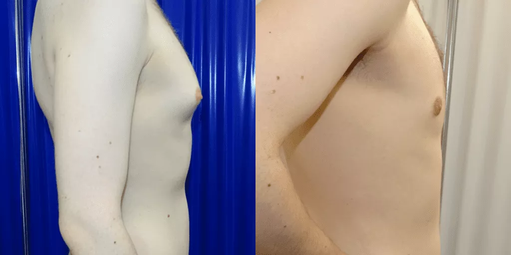 gynecomastia-removal-side-view.webp?format=webp&nv=ca64acd6-a6db-44c0-8ef1-3388dfd37a49