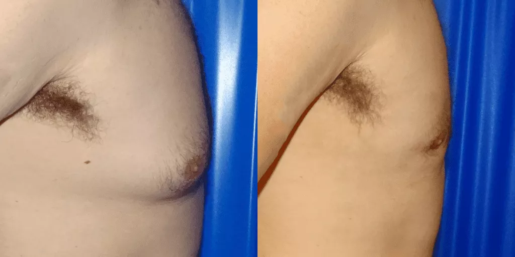 gynecomastia-results.webp?format=webp&nv=ca64acd6-a6db-44c0-8ef1-3388dfd37a49