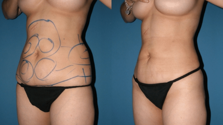 liposuction before after 5