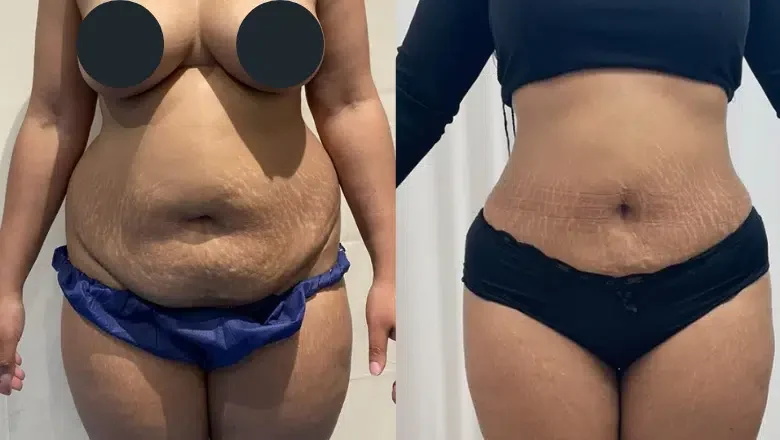 liposuction before after 8