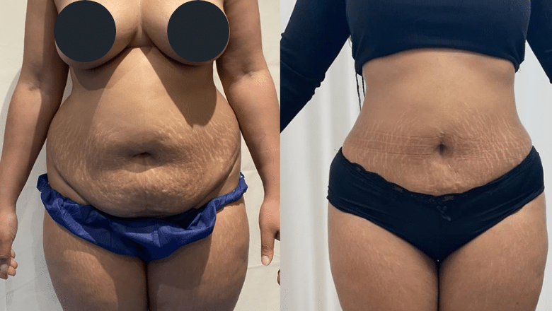 Can 360° Liposuction Prevent Obesity?