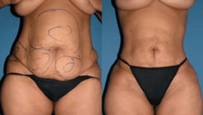 liposuction before after 8