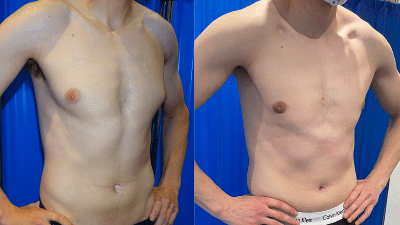 male breast reduction before after 5