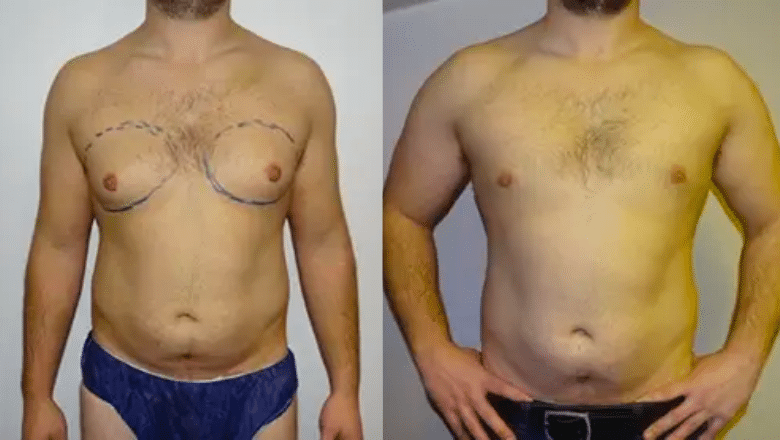 male breast reduction before and after photos (1)