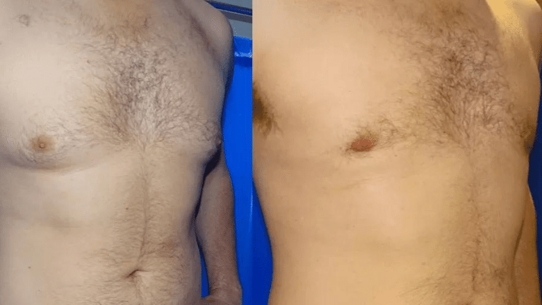 male breast reduction surgery before and after photos