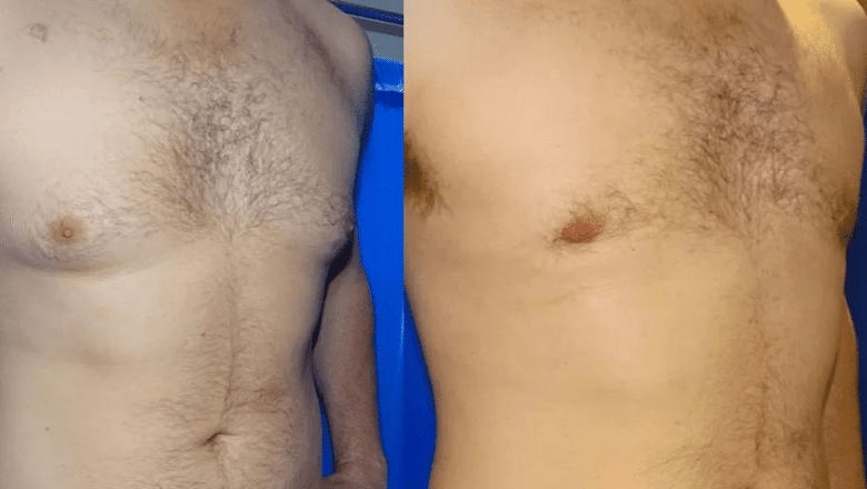 male breast reduction surgery before and after photos 