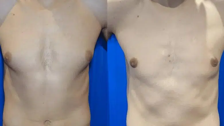 male breast reduction before and after photos 