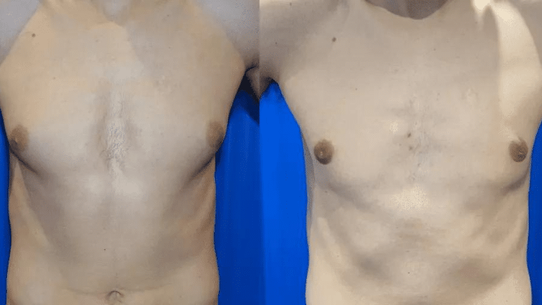 male breast reduction before and after photos