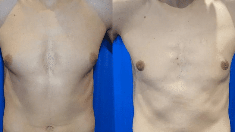 Breast Reduction Surgery : Before and After Photos