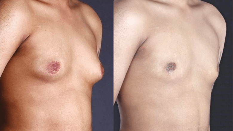 BodyTite gynecomastia