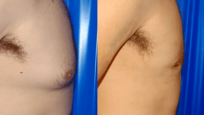 male breast reduction before and after photos