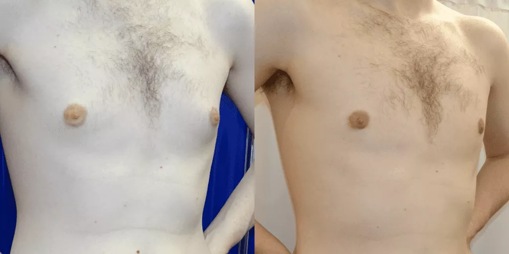 male-breast-reduction-results.webp?format=webp&nv=ca64acd6-a6db-44c0-8ef1-3388dfd37a49