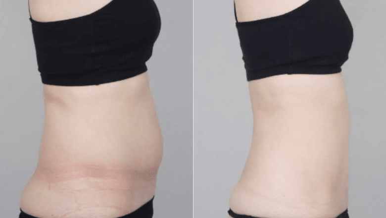 stomach liposuction before and after side view