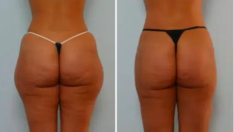 thigh liposuction before and after