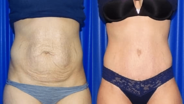 tummy tuck before after 11