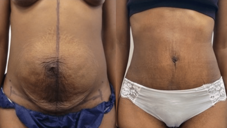 tummy tuck before after 3