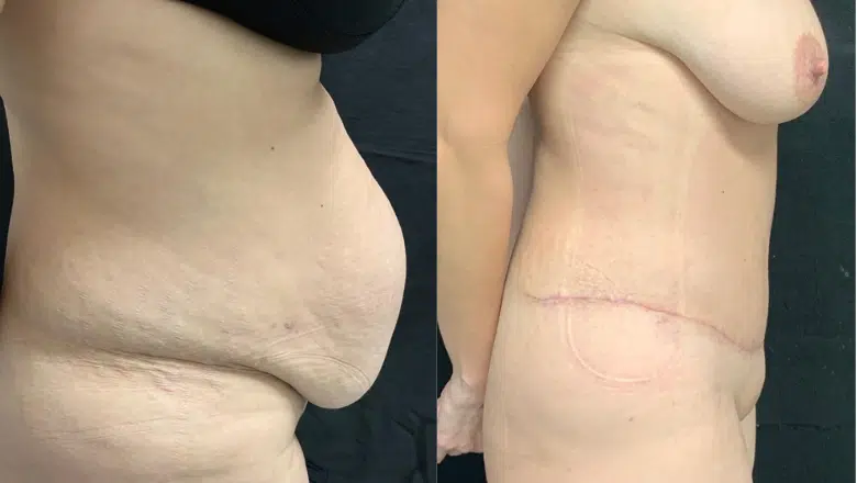 tummy-tuck-results-before-and-after-side