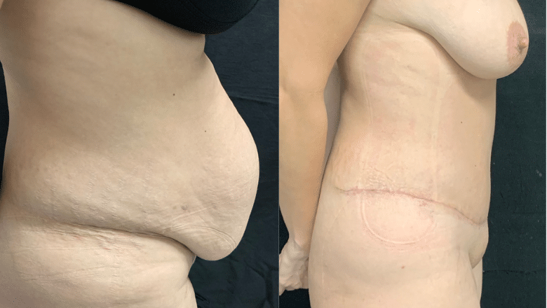tummy tuck results before and after side view