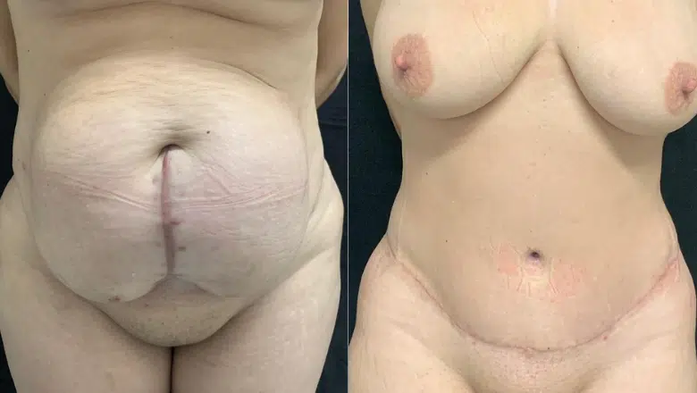 tummy-tuck-results-before-and-after.png.webp?format=webp&nv=212368fc-2000-40d1-9026-c0f94abda644