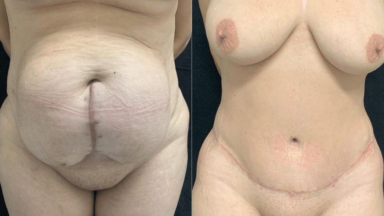 tummy tuck results before and after