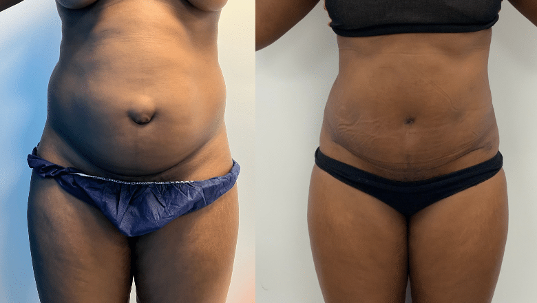 tummy tuck with hernia repair results