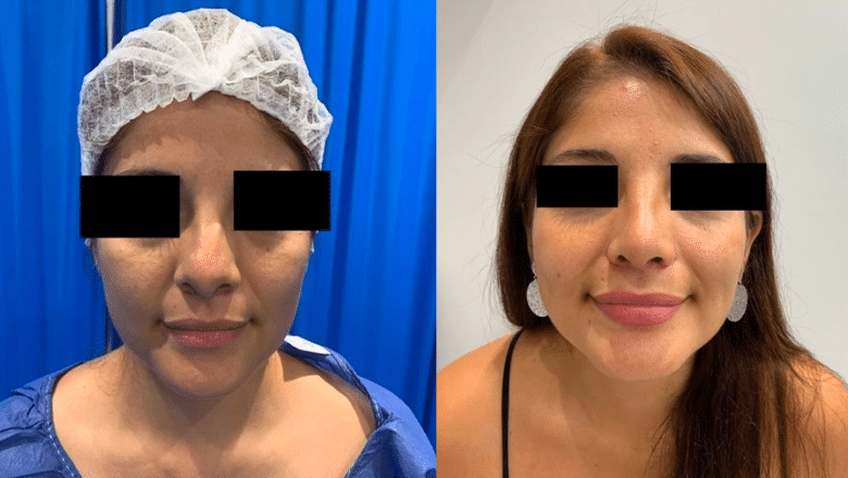 ultrasonic rhinoplasty before and after