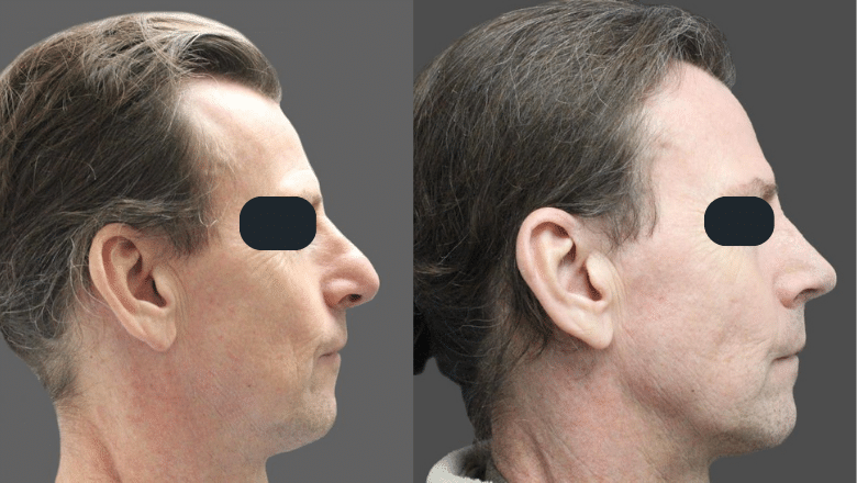 revision rhinoplasty before after 1