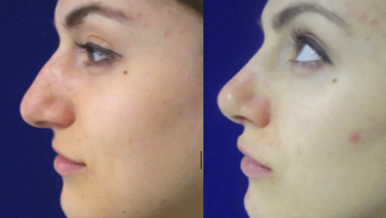 nose reshaping before and after