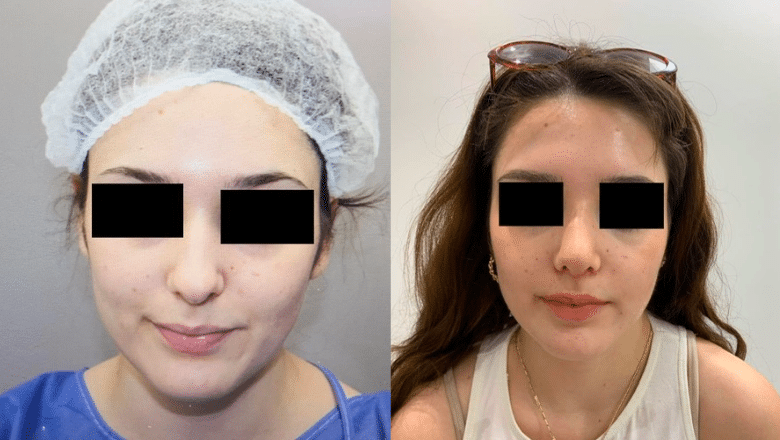 ultrasonic rhinoplasty before and after