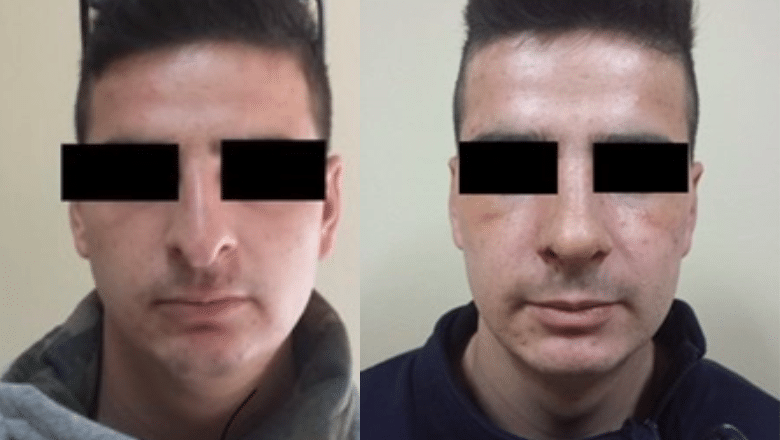 male nose surgery before and after