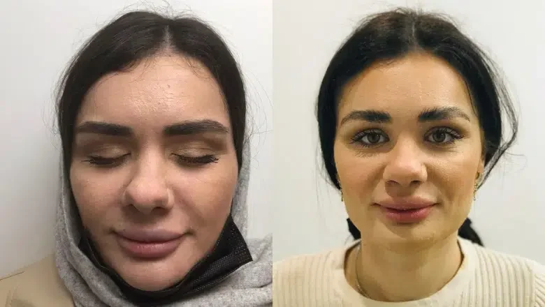 female nose job before after