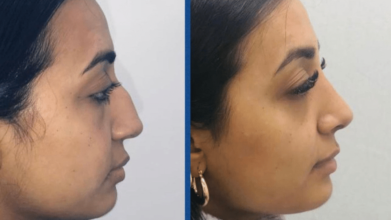 indian pakistani rhinoplasty before after side view