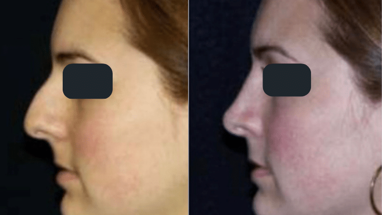 rhinoplasty before after 5