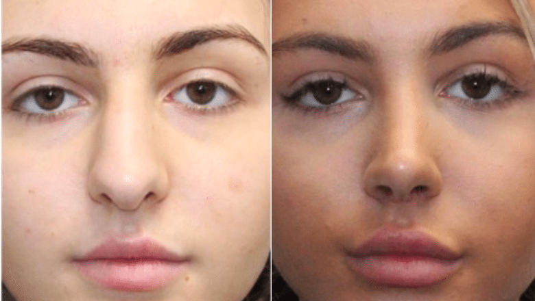 nose job before and after