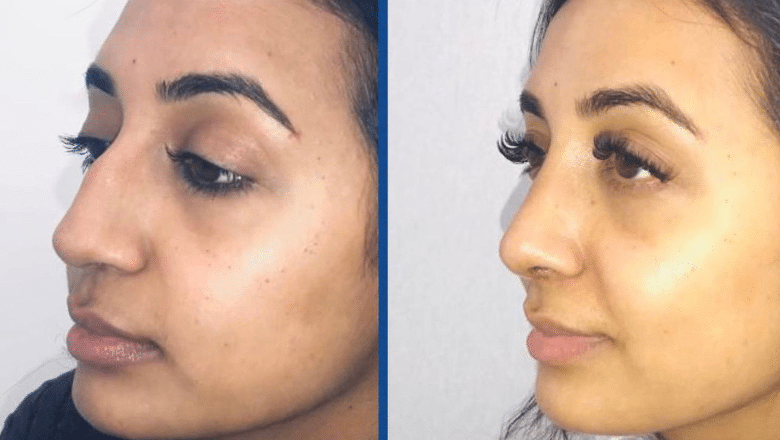 indian pakistani rhinoplasty before after oblique view