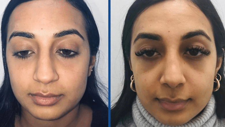 indian pakistani rhinoplasty before after front view