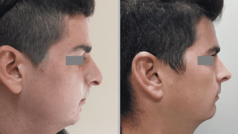 male nose job before after side view