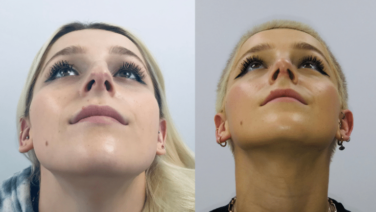 Nasal Rhinotomy Understanding Nose Anatomy - The Ultimate Guide to Rhinoplasty | Centre ...