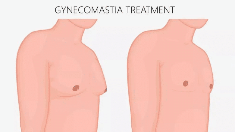 Gynecomastia Treatment Options - chest fat vs gynecomastia