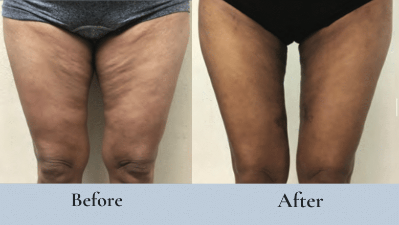 Thigh lift before after 6