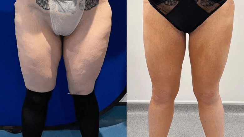 inner thigh lift surgery before and after photos