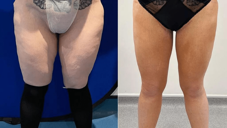 inner thigh lift surgery before and after photos 