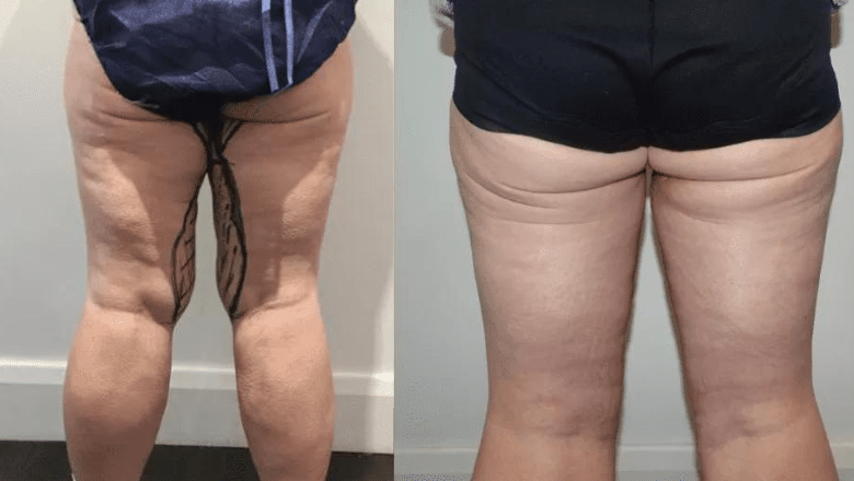 inner thigh lift before and after photos